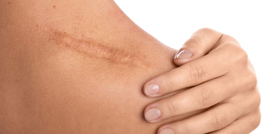 Scar Care 2.0: CBD Cream Post-Surgery to Reduce Redness, Itch & Scar Thickness